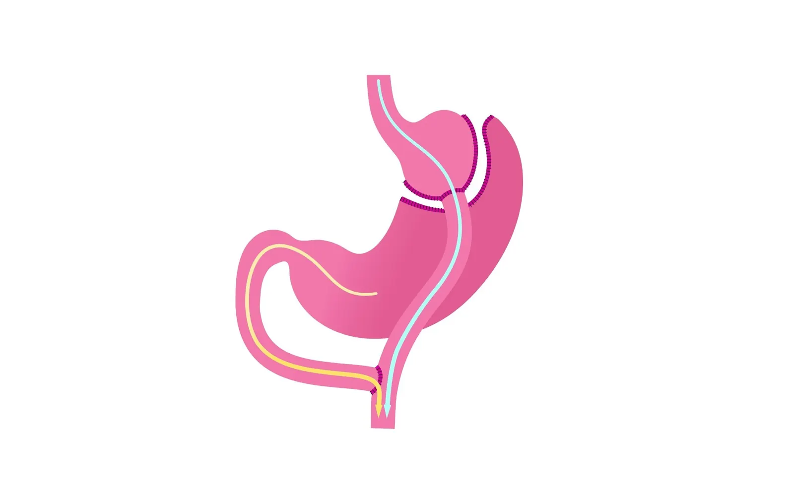 Ilustração da cirurgia bariátrica bypass gástrico em Y de Roux
