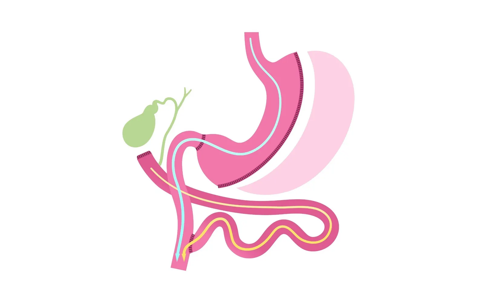 Ilustração da cirurgia bariátrica sleeve gástrico